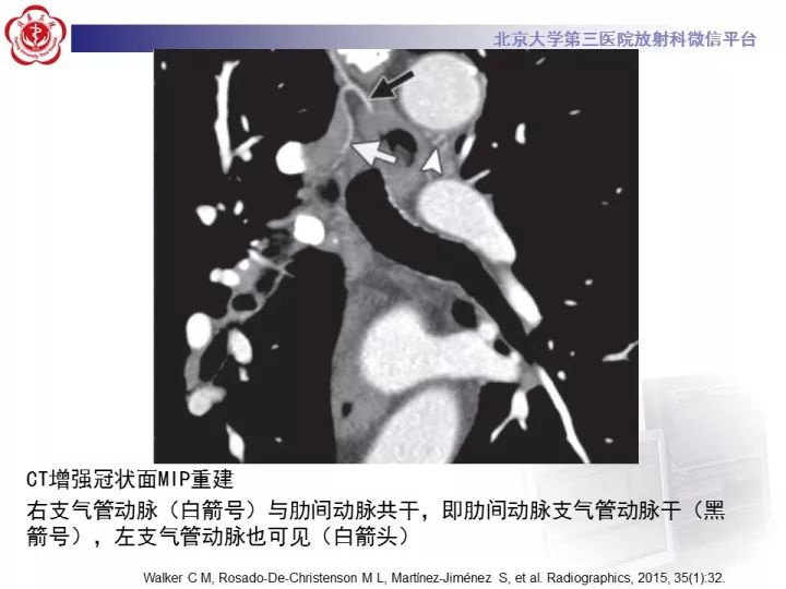 【病例】支气管动脉相关的咯血1例CT影像表现
