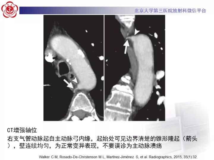 【病例】支气管动脉相关的咯血1例CT影像表现