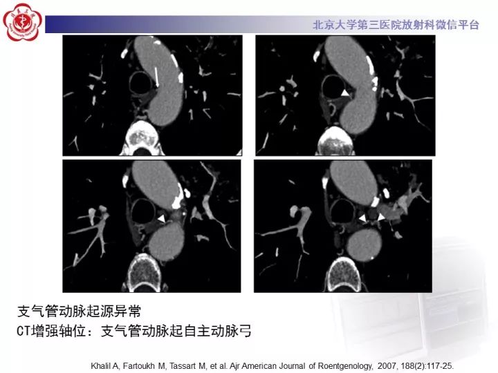 【病例】支气管动脉相关的咯血1例CT影像表现