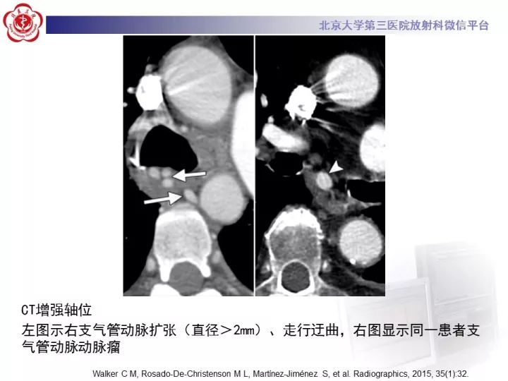 【病例】支气管动脉相关的咯血1例CT影像表现