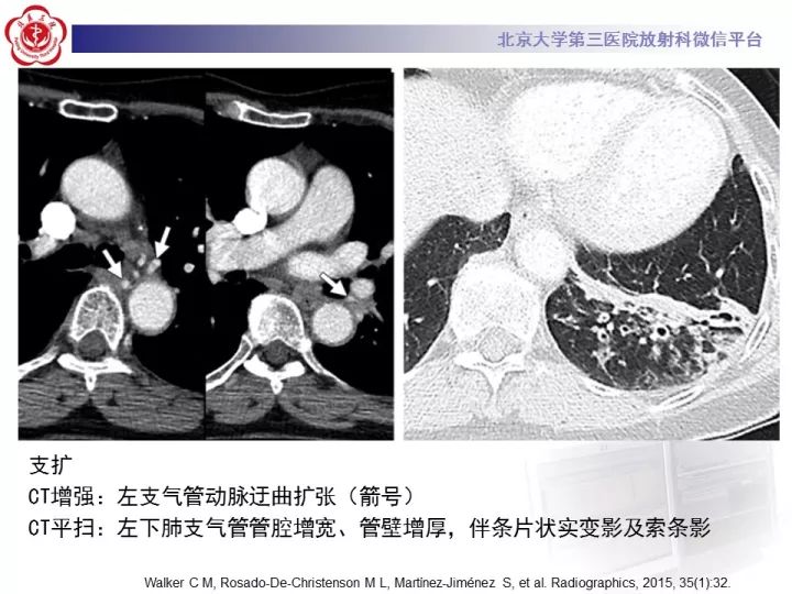 【病例】支气管动脉相关的咯血1例CT影像表现