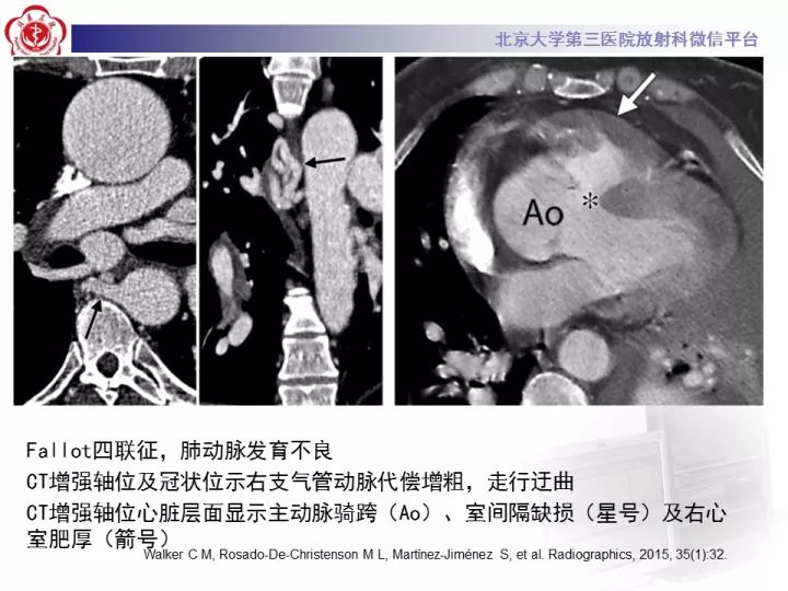 【病例】支气管动脉相关的咯血1例CT影像表现