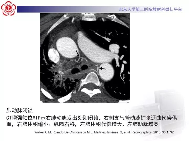 【病例】支气管动脉相关的咯血1例CT影像表现