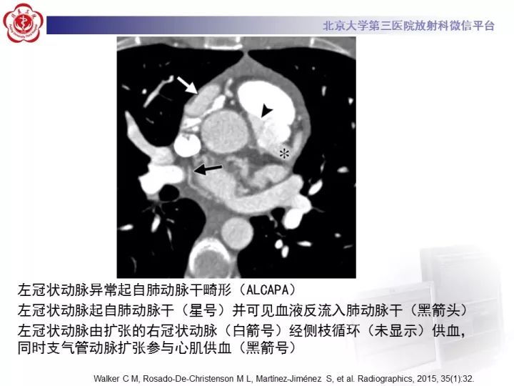 【病例】支气管动脉相关的咯血1例CT影像表现