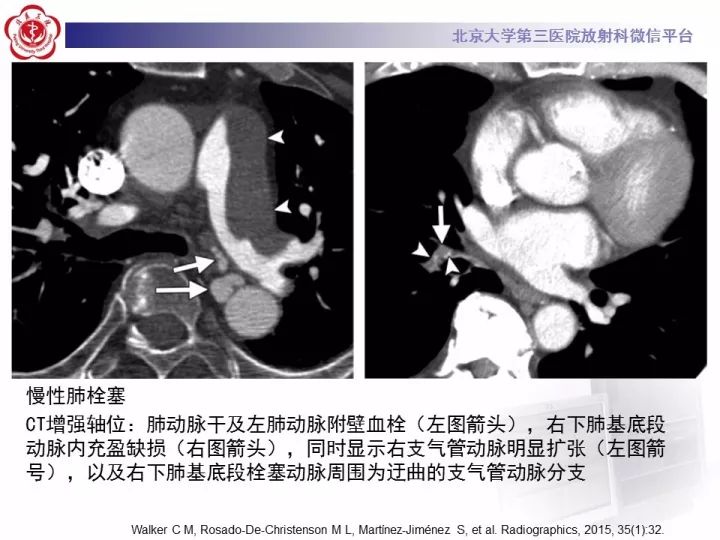 【病例】支气管动脉相关的咯血1例CT影像表现