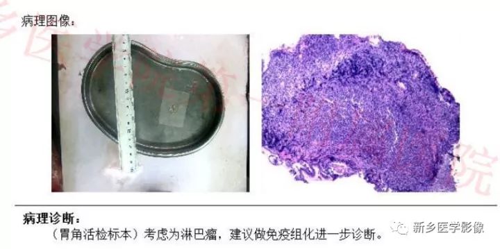 【病例】胃淋巴瘤1例CT影像表现 【病例】胃淋巴瘤1例CT影像表现
