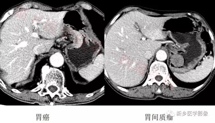 【病例】胃淋巴瘤1例CT影像表现 【病例】胃淋巴瘤1例CT影像表现