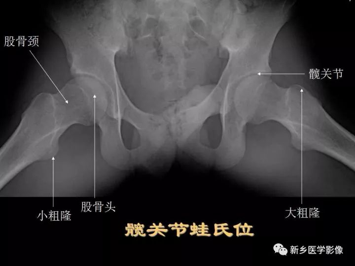 详细的髋关节X线解剖+摄影技术+测量方法 详细的髋关节X线解剖+摄影技术+测量方法