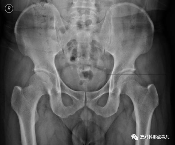详细的髋关节X线解剖+摄影技术+测量方法 详细的髋关节X线解剖+摄影技术+测量方法