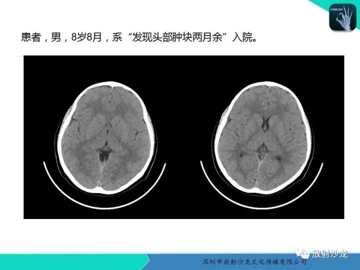 【病例】骨促结缔组织增生性纤维瘤1例CT
