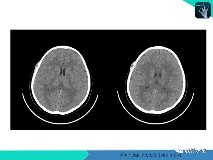【病例】骨促结缔组织增生性纤维瘤1例CT