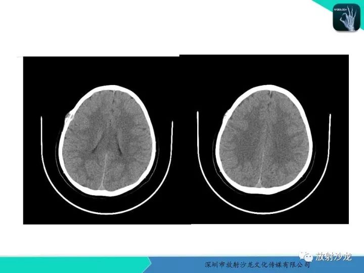 【病例】骨促结缔组织增生性纤维瘤1例CT