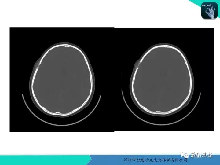 【病例】骨促结缔组织增生性纤维瘤1例CT