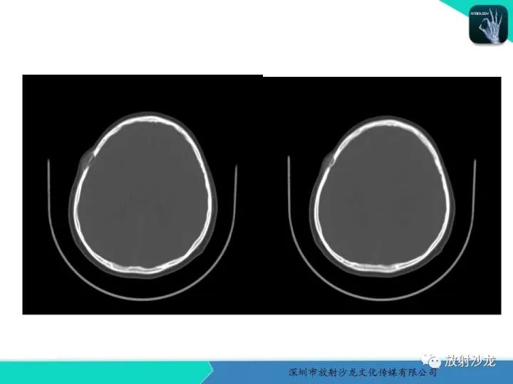 【病例】骨促结缔组织增生性纤维瘤1例CT