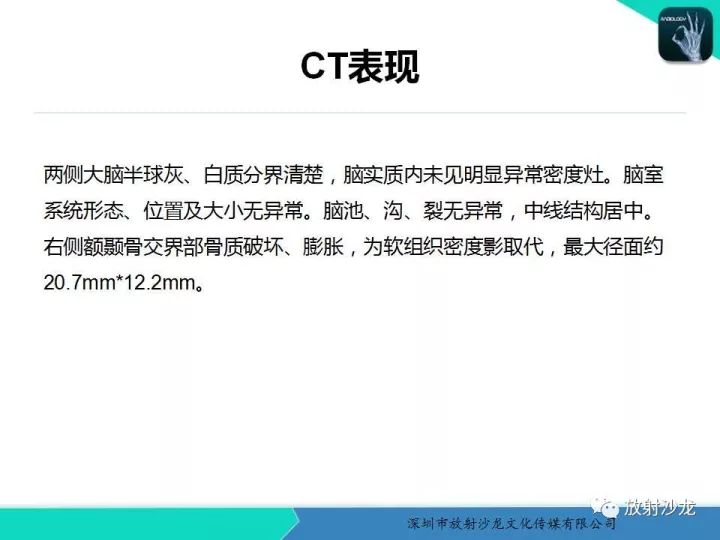 【病例】骨促结缔组织增生性纤维瘤1例CT