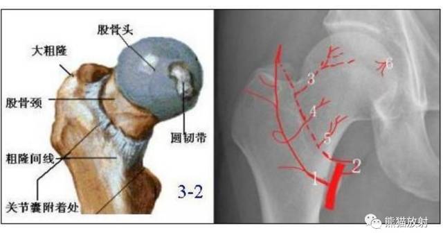 股骨头缺血性坏死分期及X、CT、MRI表现 股骨头缺血性坏死分期及X、CT、MRI表现