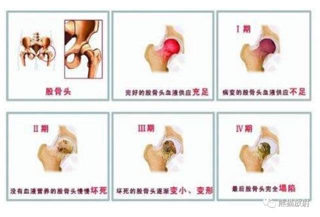 股骨头缺血性坏死分期及X、CT、MRI表现 股骨头缺血性坏死分期及X、CT、MRI表现