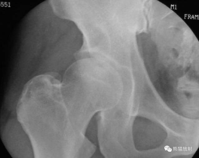 股骨头缺血性坏死分期及X、CT、MRI表现 股骨头缺血性坏死分期及X、CT、MRI表现