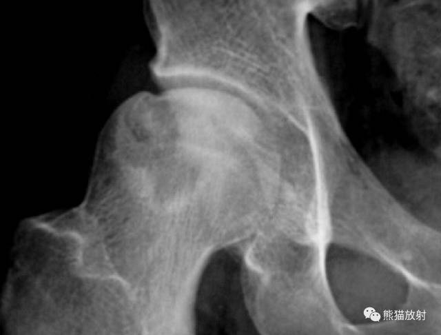 股骨头缺血性坏死分期及X、CT、MRI表现 股骨头缺血性坏死分期及X、CT、MRI表现
