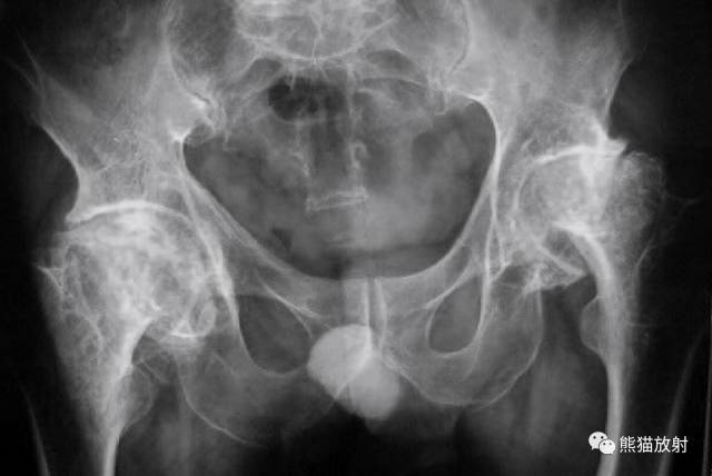股骨头缺血性坏死分期及X、CT、MRI表现 股骨头缺血性坏死分期及X、CT、MRI表现