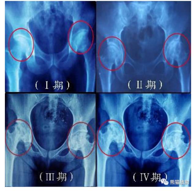 股骨头缺血性坏死分期及X、CT、MRI表现 股骨头缺血性坏死分期及X、CT、MRI表现