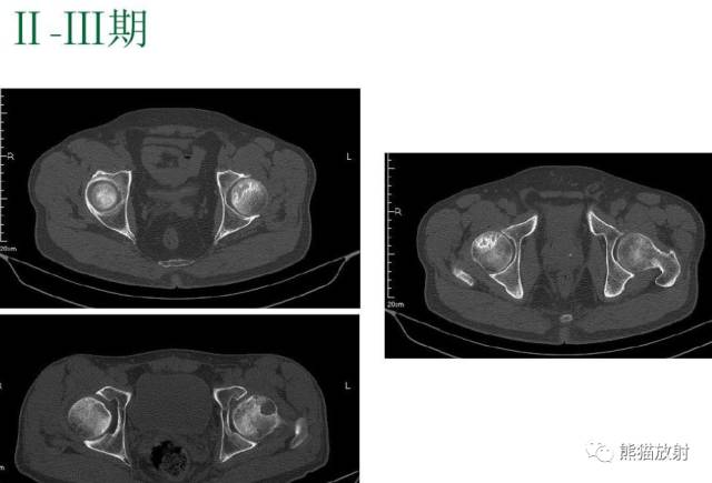 股骨头缺血性坏死分期及X、CT、MRI表现 股骨头缺血性坏死分期及X、CT、MRI表现