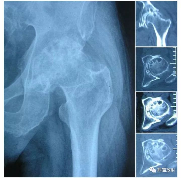 股骨头缺血性坏死分期及X、CT、MRI表现 股骨头缺血性坏死分期及X、CT、MRI表现