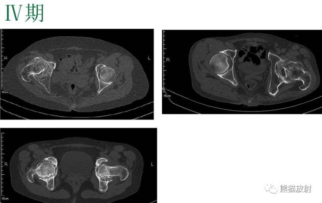 股骨头缺血性坏死分期及X、CT、MRI表现 股骨头缺血性坏死分期及X、CT、MRI表现
