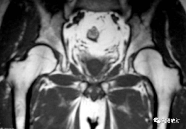 股骨头缺血性坏死分期及X、CT、MRI表现 股骨头缺血性坏死分期及X、CT、MRI表现
