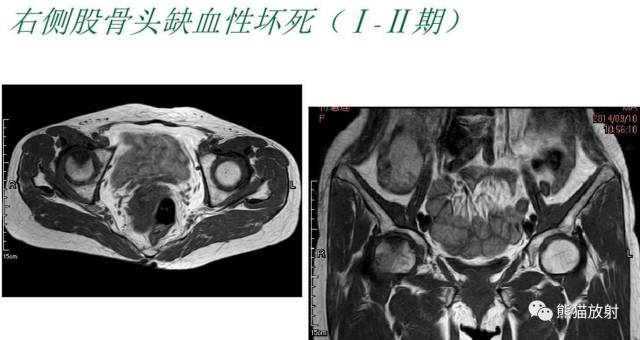 股骨头缺血性坏死分期及X、CT、MRI表现 股骨头缺血性坏死分期及X、CT、MRI表现