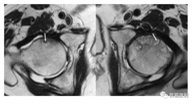 股骨头缺血性坏死分期及X、CT、MRI表现 股骨头缺血性坏死分期及X、CT、MRI表现