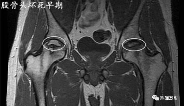 股骨头缺血性坏死分期及X、CT、MRI表现 股骨头缺血性坏死分期及X、CT、MRI表现