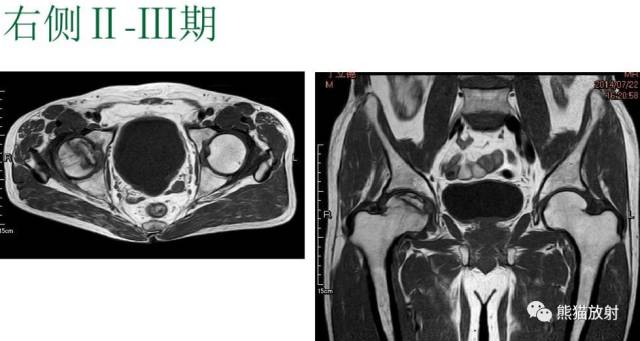 股骨头缺血性坏死分期及X、CT、MRI表现 股骨头缺血性坏死分期及X、CT、MRI表现