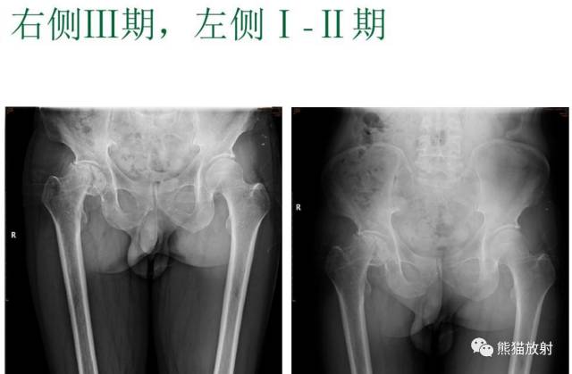 股骨头缺血性坏死分期及X、CT、MRI表现 股骨头缺血性坏死分期及X、CT、MRI表现