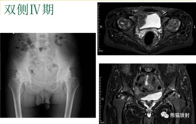 股骨头缺血性坏死分期及X、CT、MRI表现 股骨头缺血性坏死分期及X、CT、MRI表现