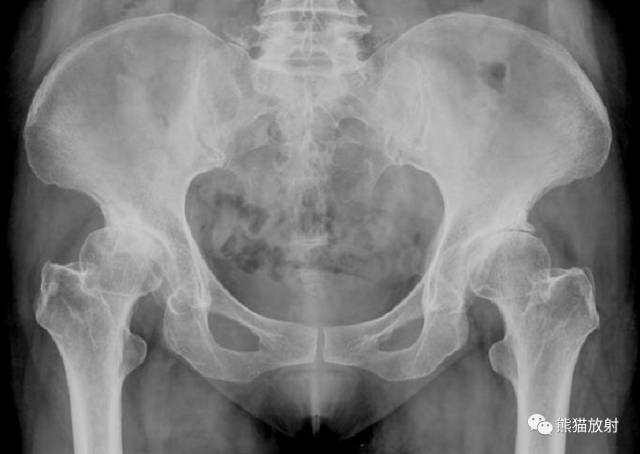 股骨头缺血性坏死分期及X、CT、MRI表现 股骨头缺血性坏死分期及X、CT、MRI表现