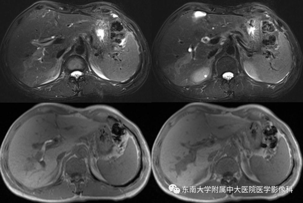【病例】肝细胞癌合并胆管癌栓1例CT及MR影像表现