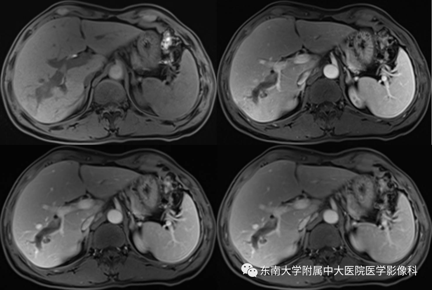 【病例】肝细胞癌合并胆管癌栓1例CT及MR影像表现 【病例】肝细胞癌合并胆管癌栓1例CT及MR影像表现