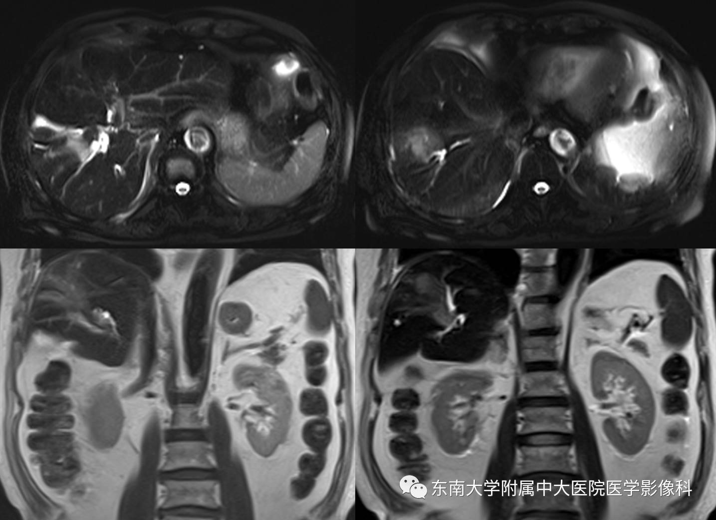 【病例】肝细胞癌合并胆管癌栓1例CT及MR影像表现 【病例】肝细胞癌合并胆管癌栓1例CT及MR影像表现
