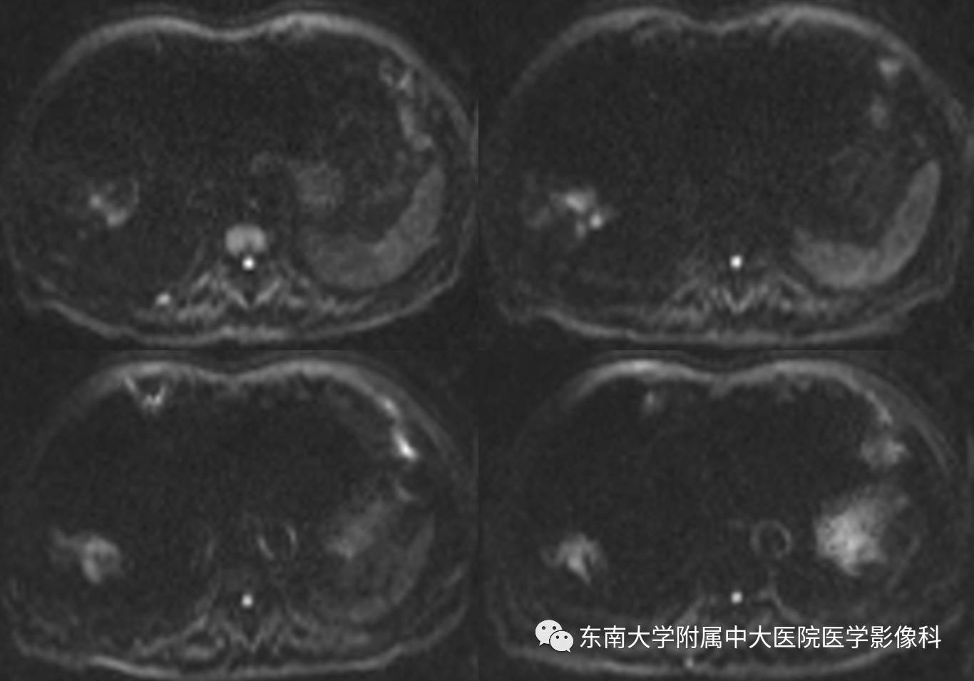 【病例】肝细胞癌合并胆管癌栓1例CT及MR影像表现 【病例】肝细胞癌合并胆管癌栓1例CT及MR影像表现
