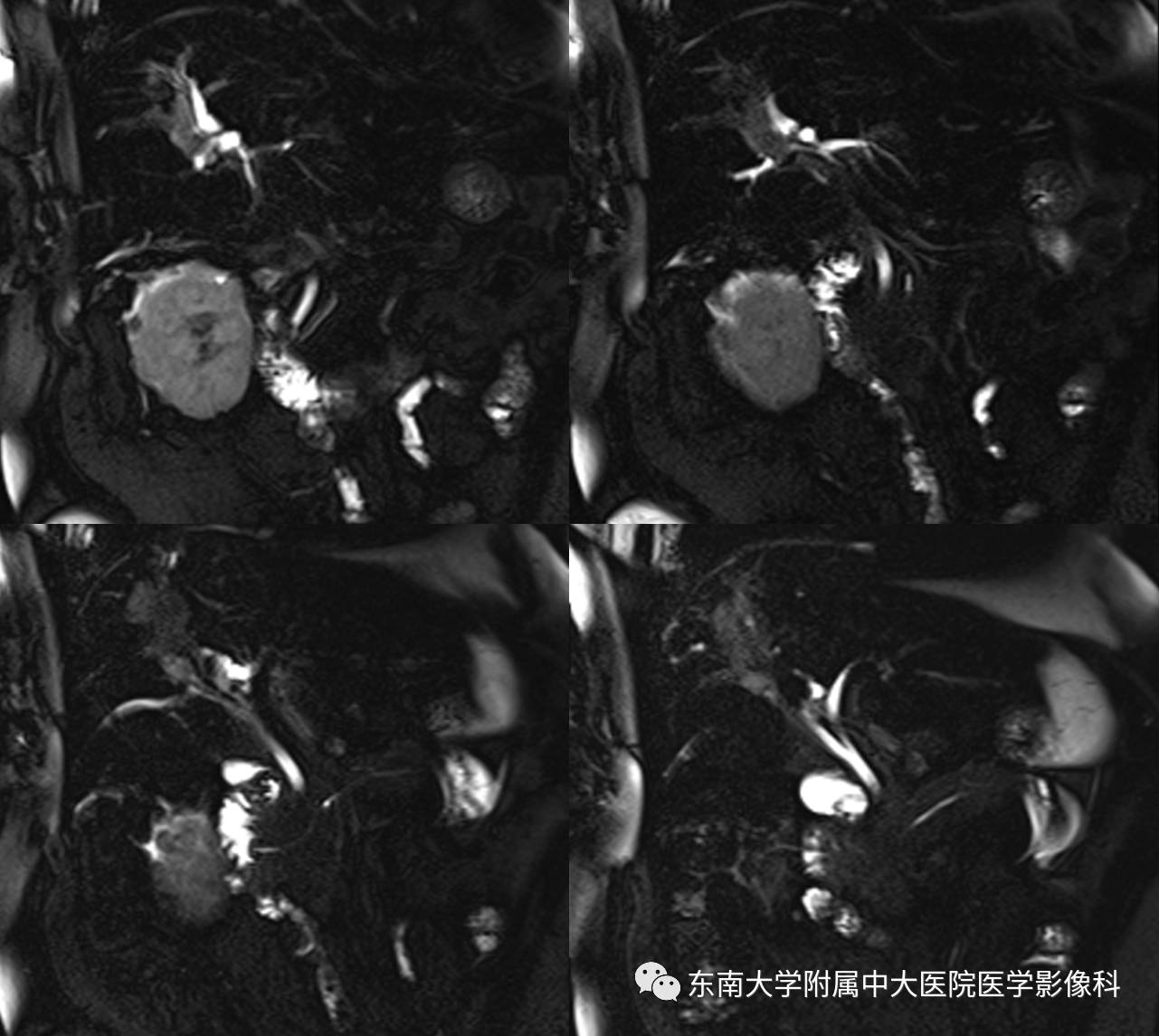 【病例】肝细胞癌合并胆管癌栓1例CT及MR影像表现 【病例】肝细胞癌合并胆管癌栓1例CT及MR影像表现