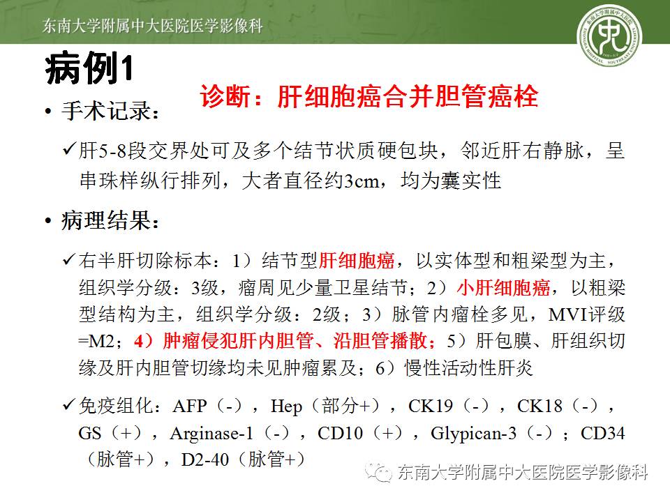 【病例】肝细胞癌合并胆管癌栓1例CT及MR影像表现 【病例】肝细胞癌合并胆管癌栓1例CT及MR影像表现