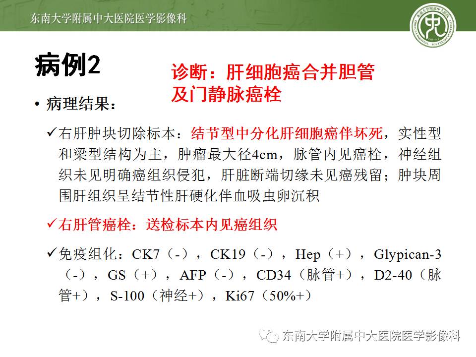 【病例】肝细胞癌合并胆管癌栓1例CT及MR影像表现 【病例】肝细胞癌合并胆管癌栓1例CT及MR影像表现