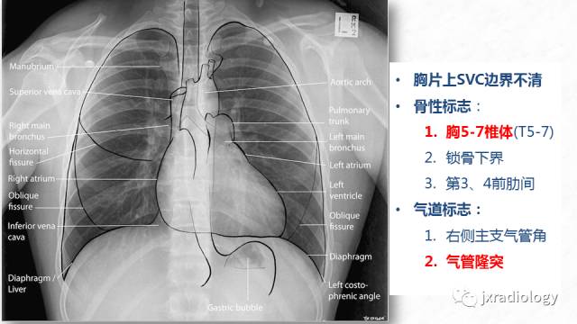 【PPT】PICC尖端的胸片定位