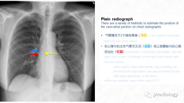 【PPT】PICC尖端的胸片定位