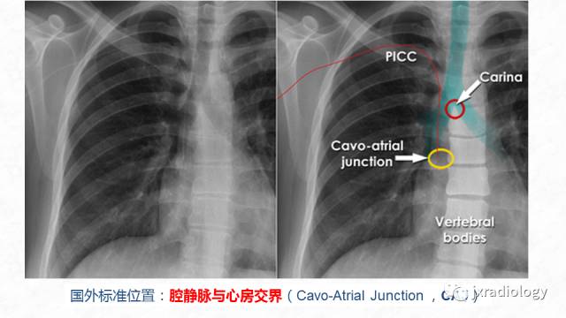【PPT】PICC尖端的胸片定位