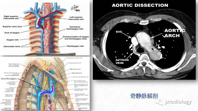 【PPT】PICC尖端的胸片定位