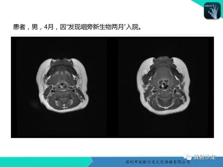 【病例】咽部畸胎瘤1例MR影像表现