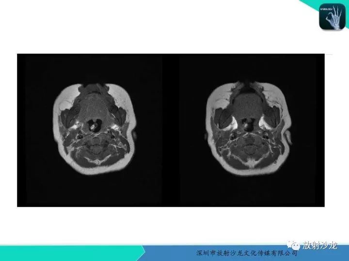 【病例】咽部畸胎瘤1例MR影像表现