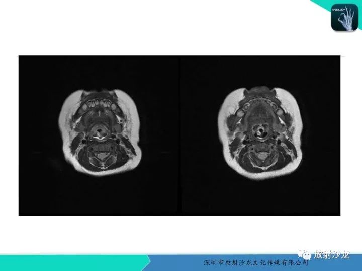 【病例】咽部畸胎瘤1例MR影像表现